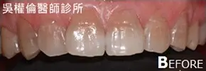 陶瓷貼片 2 3920855