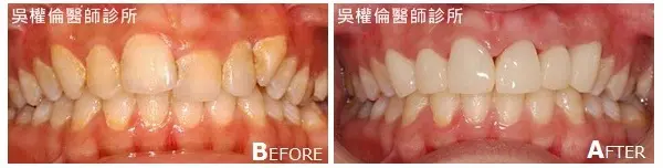 全瓷冠案例