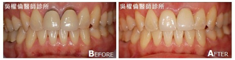 全瓷冠案例劉小姐