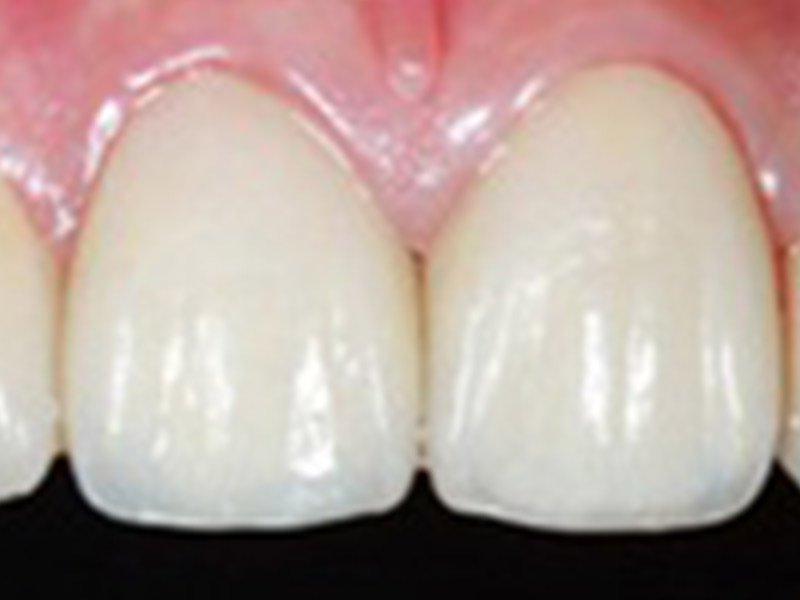 宜蘭植牙新聞│口腔健康－全瓷冠比傳統瓷牙更美觀 又容易打理