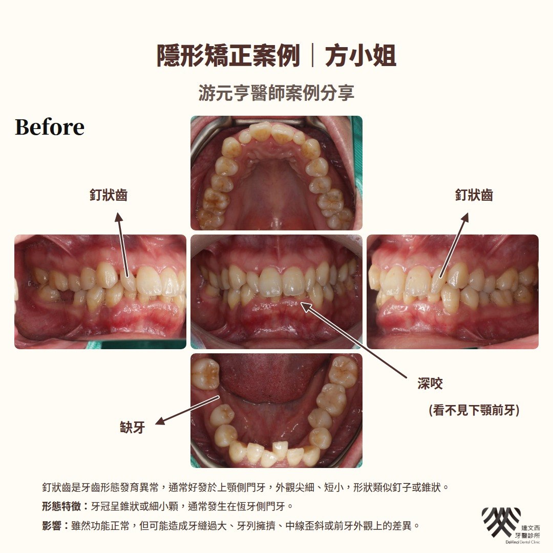 游元亨醫師-隱適美矯正案例方小姐-1