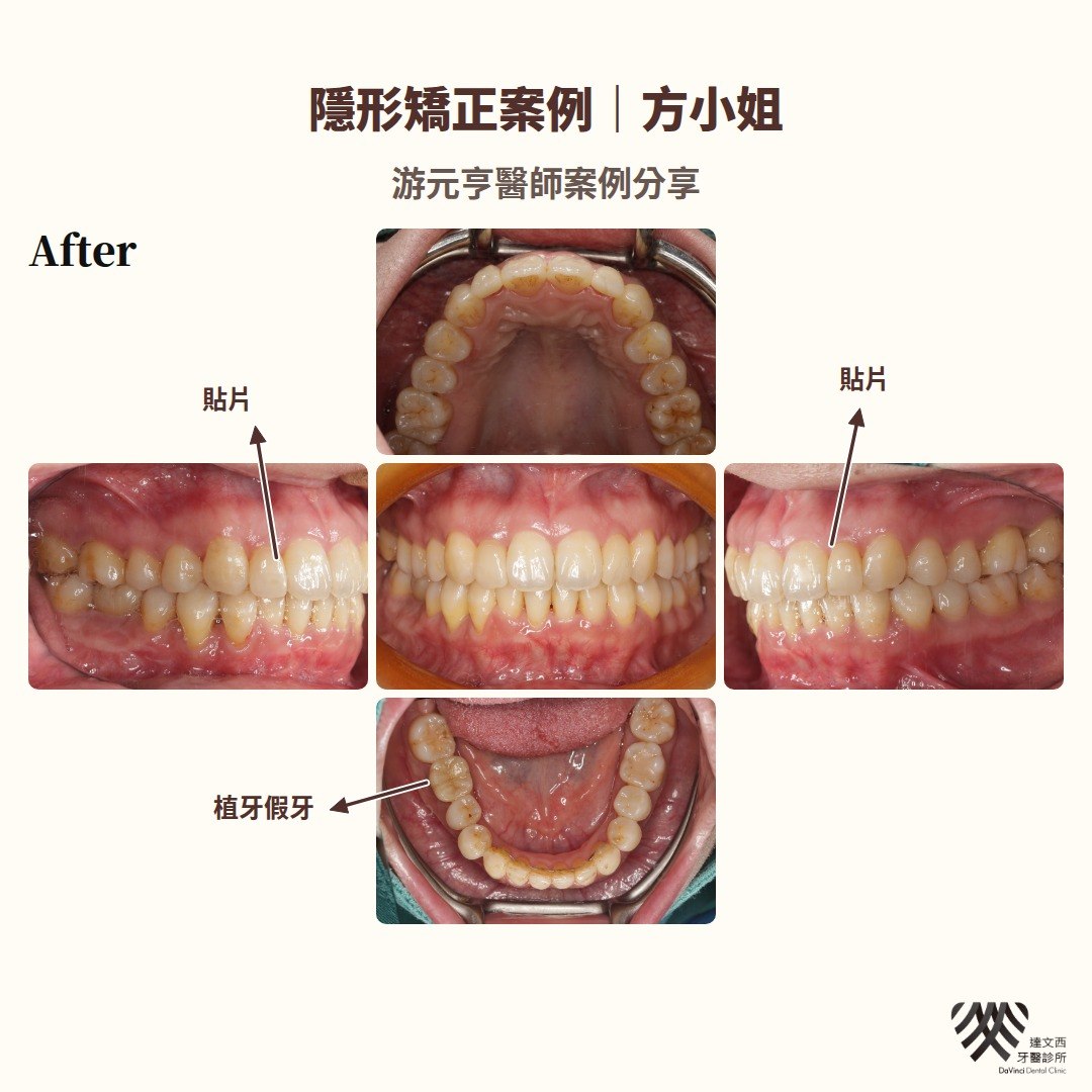 游元亨醫師-隱適美矯正案例方小姐-2
