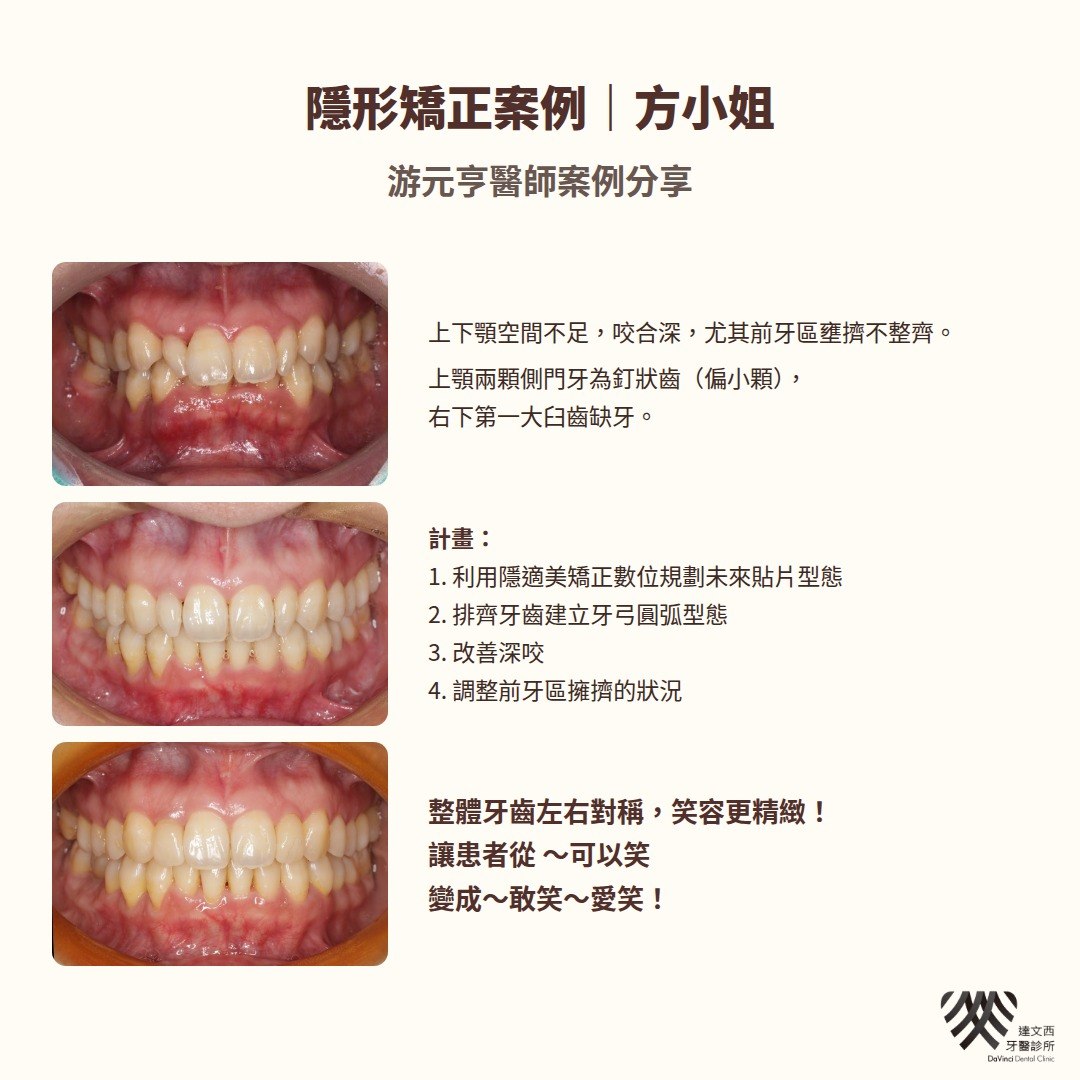 游元亨醫師-隱適美矯正案例方小姐-3