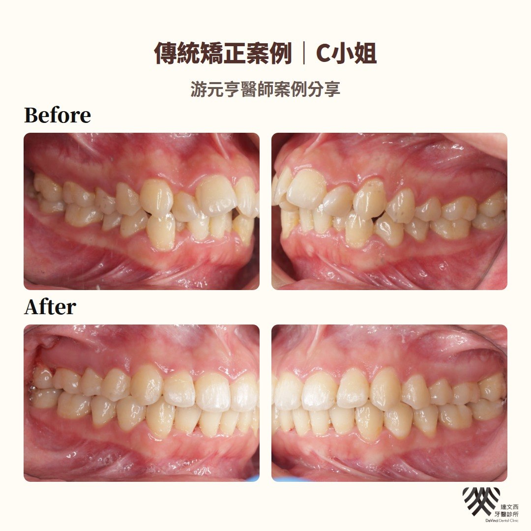游元亨醫師-傳統矯正案例C小姐-3