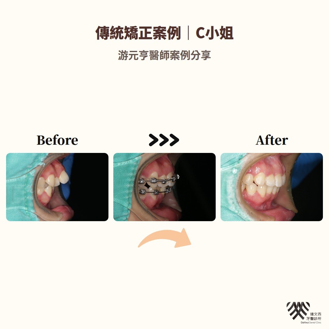 游元亨醫師-傳統矯正案例C小姐-4