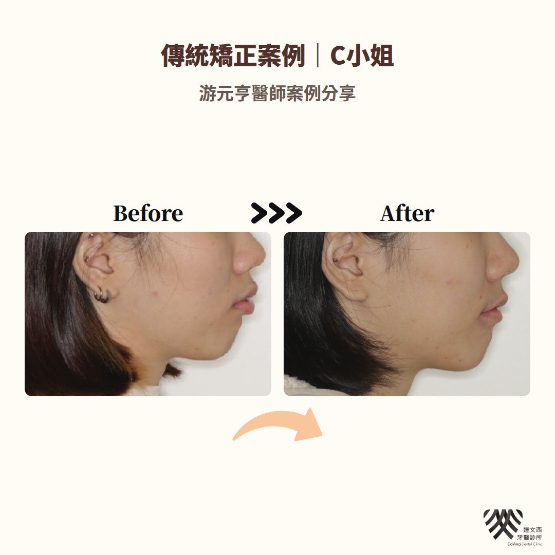 游元亨醫師-傳統矯正案例C小姐-5