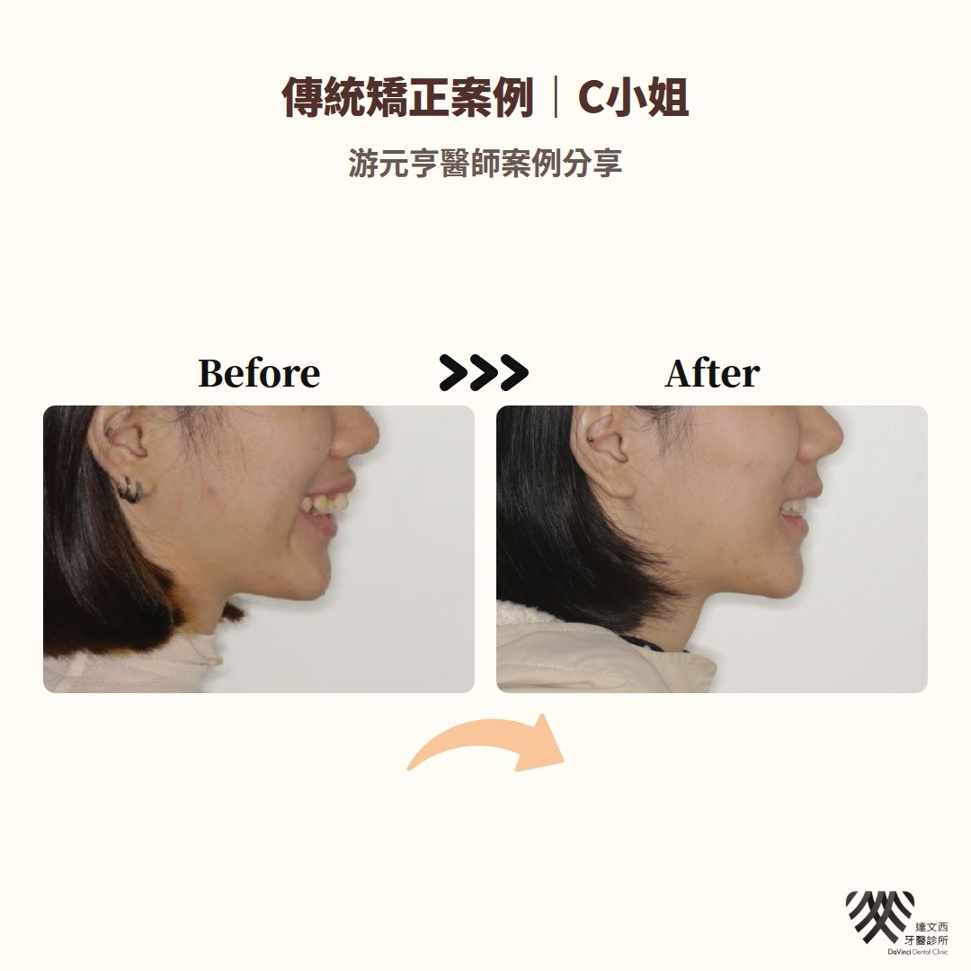 游元亨醫師-傳統矯正案例C小姐-6