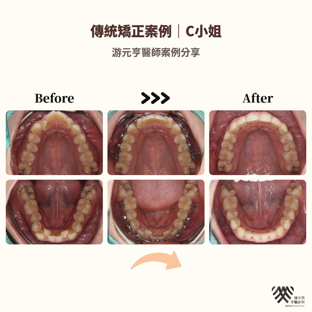 游元亨醫師-傳統矯正案例C小姐-7