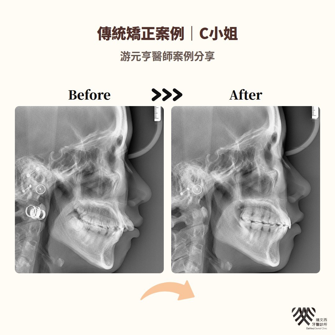 游元亨醫師-傳統矯正案例C小姐-8